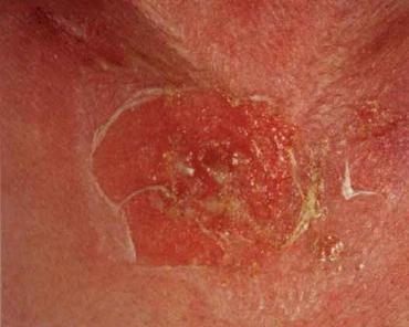 Staphylococcal Scalded Skin Syndrome - Skin Disorders ...