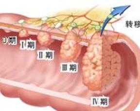 结肠癌早期症状