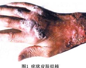 疣状皮肤结核 - 搜狗百科