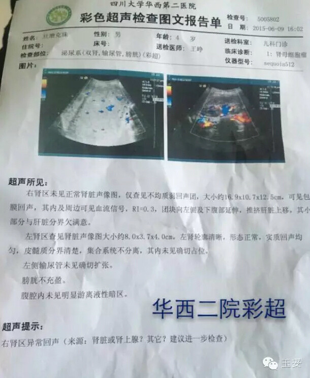 年仅4岁的藏族孩子——旦增克珠身患右肾母细胞瘤,现在天津肿瘤医院