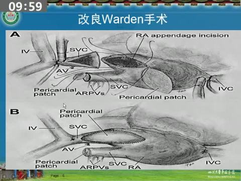 改良Warden手术治疗肺静脉汇入上腔静脉的中期随访结果 2