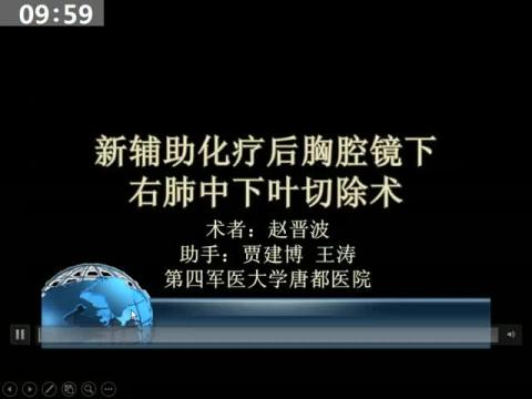 新辅助化疗后胸腔镜下右肺中下叶切除术