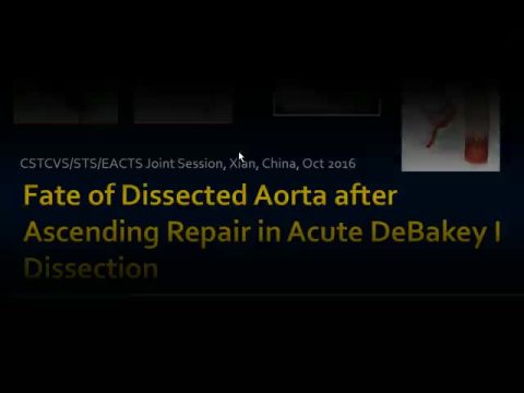 Fate of Dissected Aortic Arch after Ascending Replacement in Acute Type A Aortic Dissection