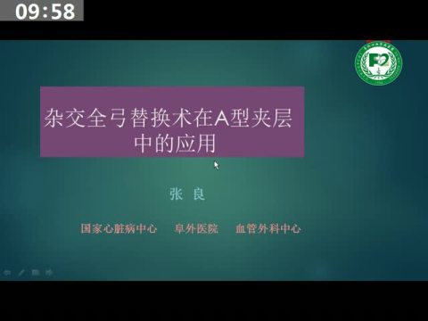 杂交全弓替换术在A型主动脉夹层中的应用