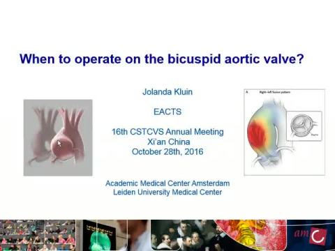 When to Operate on the Bicuspid Aortic Valve?