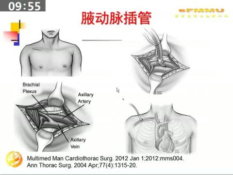 回顾性分析不同动脉插管方式对主动脉夹层手术预后的影响| 2