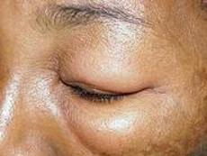 血管神经性水肿