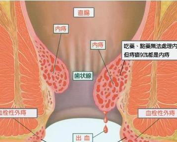 痔出血