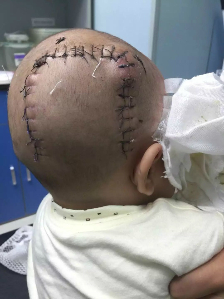 在孩子四个多月的时候,孩子不小心摔跤摔到了头,医生给做了开颅手术