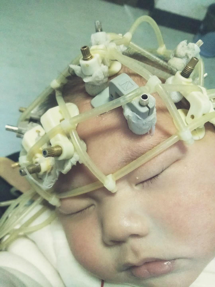 新生宝宝确诊先天性巨脑回畸形