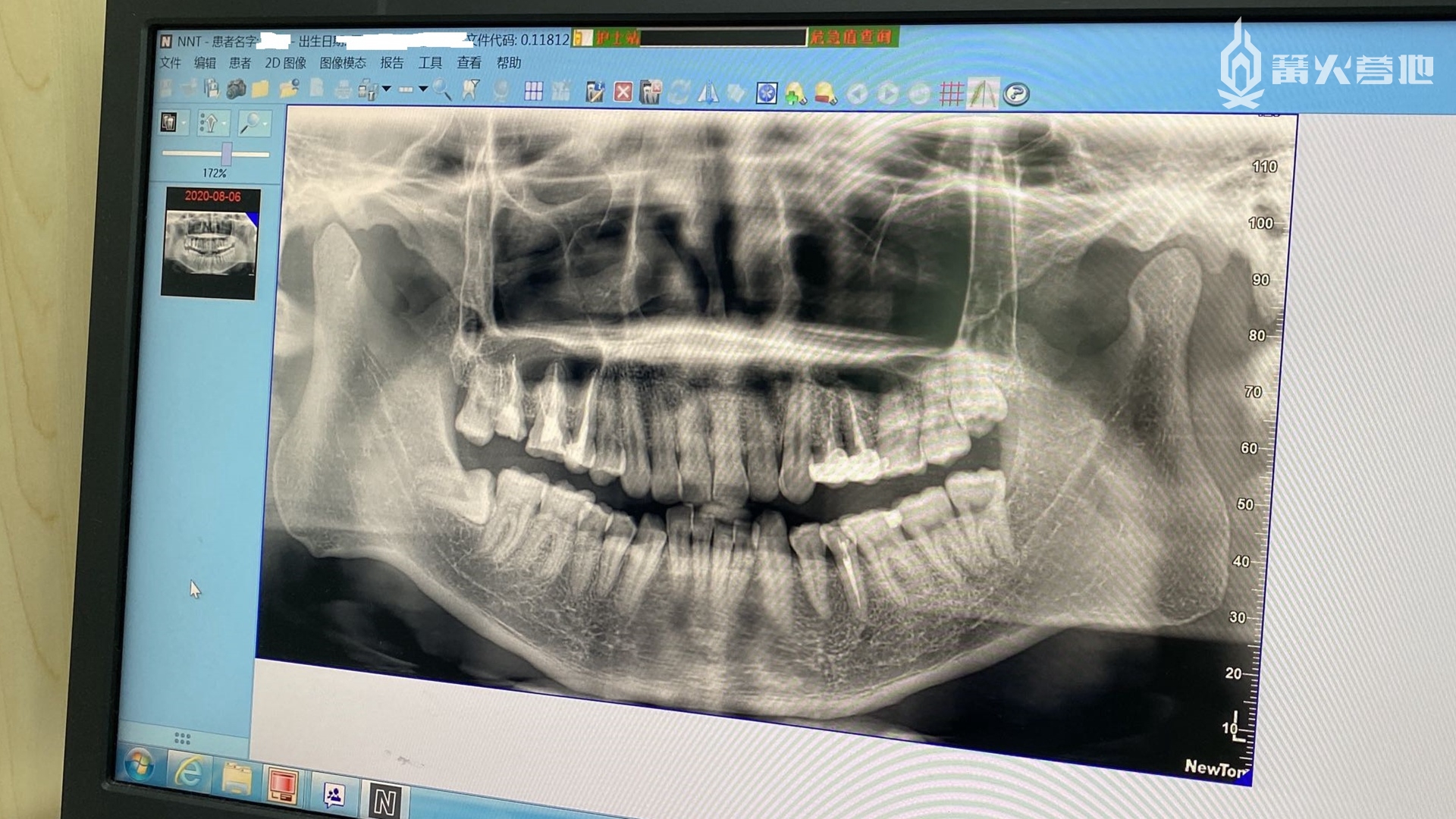 一张旧照片，当时四颗智齿都在，有细线深入牙髓的是做过根管的牙