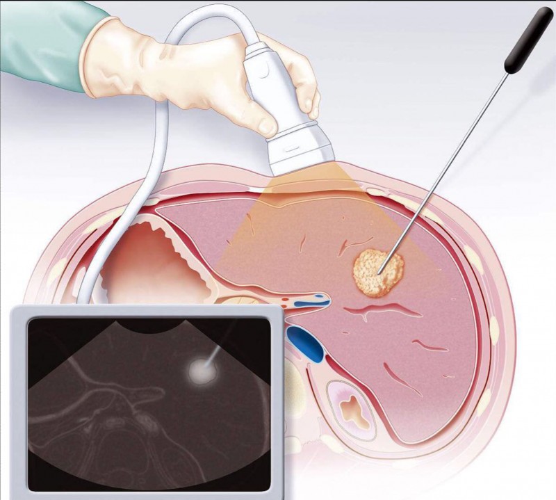 中山七院联合中山大学肿瘤防治中心开展肝癌微波消融治疗
